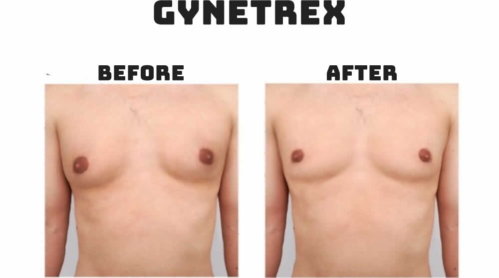 before after Gynetrex