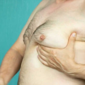 eliminates male breast deposits